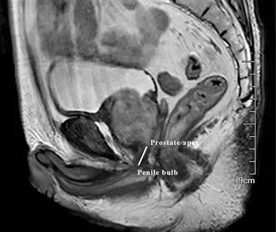 A retrospective study to evaluate the effect of preoperative hormonal therapy on continence recovery